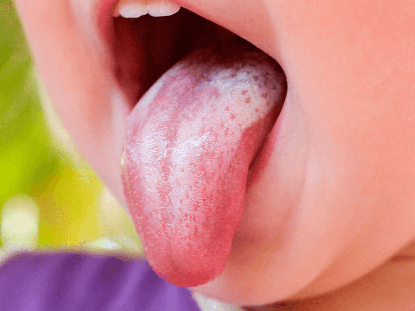 Oral thrush/bercak putih pada mulut